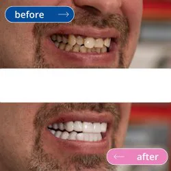 لمینت دندان دو فک مدل TruSmile به همراه نوار چسب سفیدکننده دندان